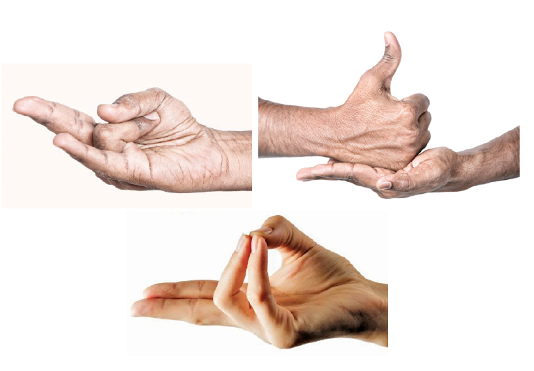 NOT-SO-COMMON TREATMENT FOR THE COMMON COLD